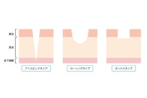 2-1. リジュランで改善が見込めるニキビ跡の種類