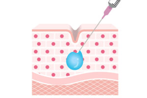 1-2. リジュラン注射で感じる「2種類の痛み」とその原因